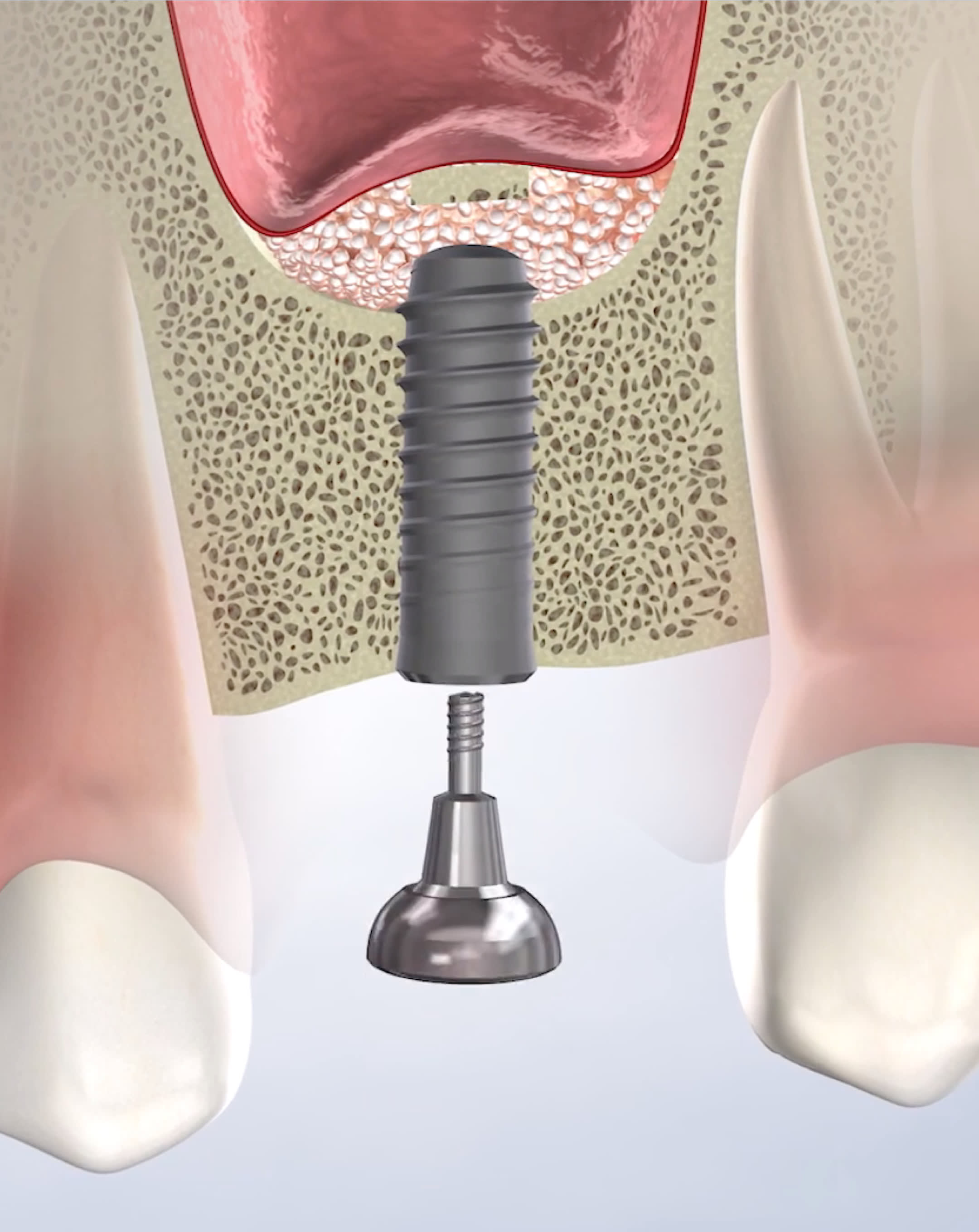 Bone grafting procedure mobile