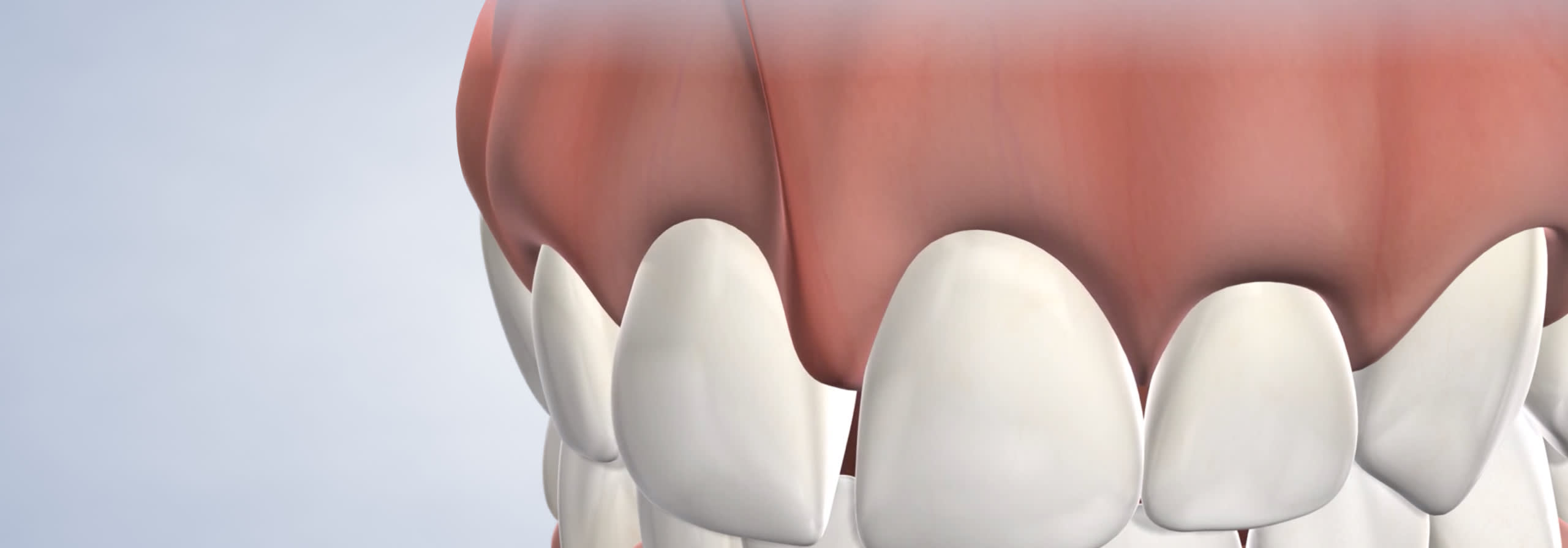 Frenectomy procedure desktop