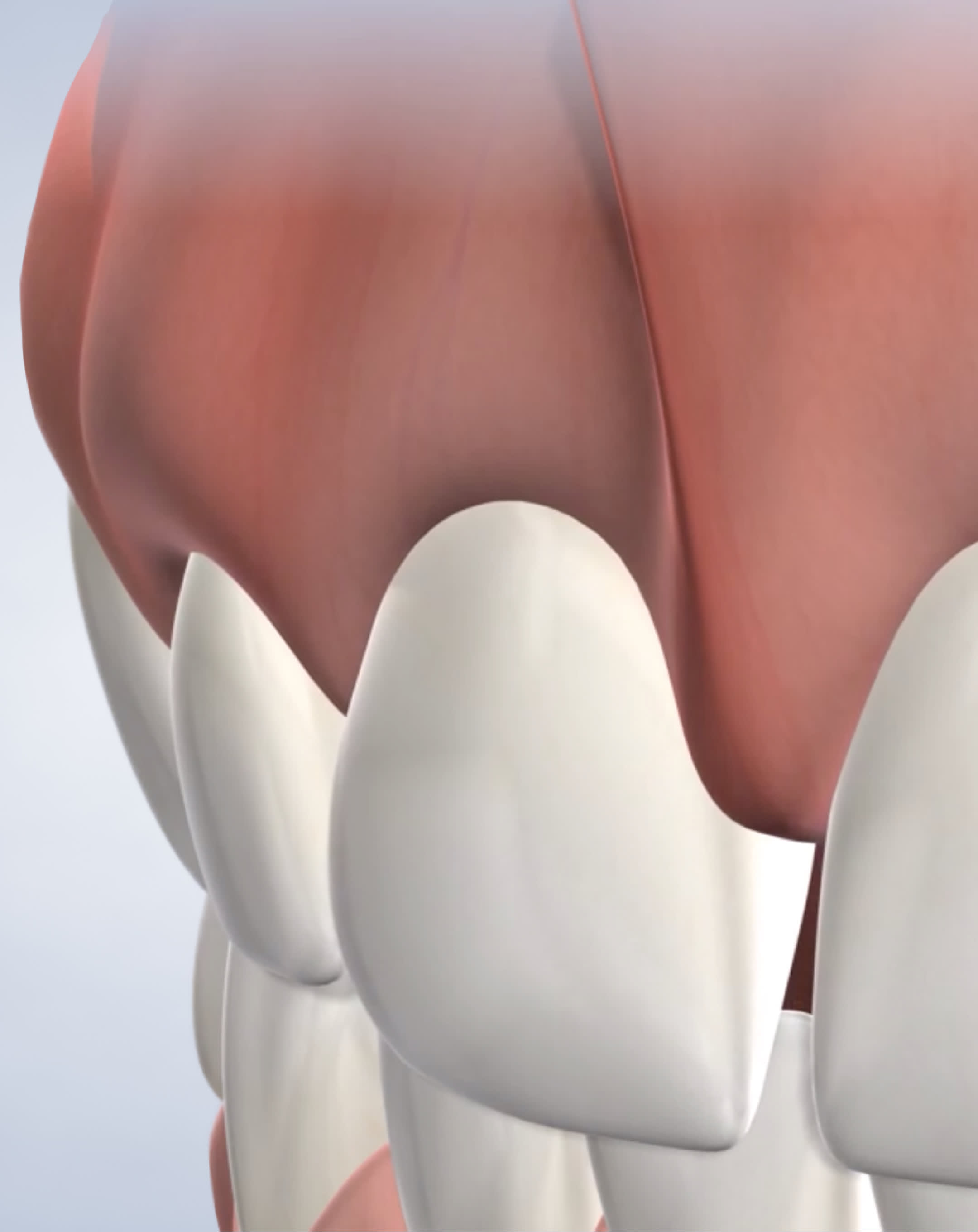 Frenectomy procedure mobile