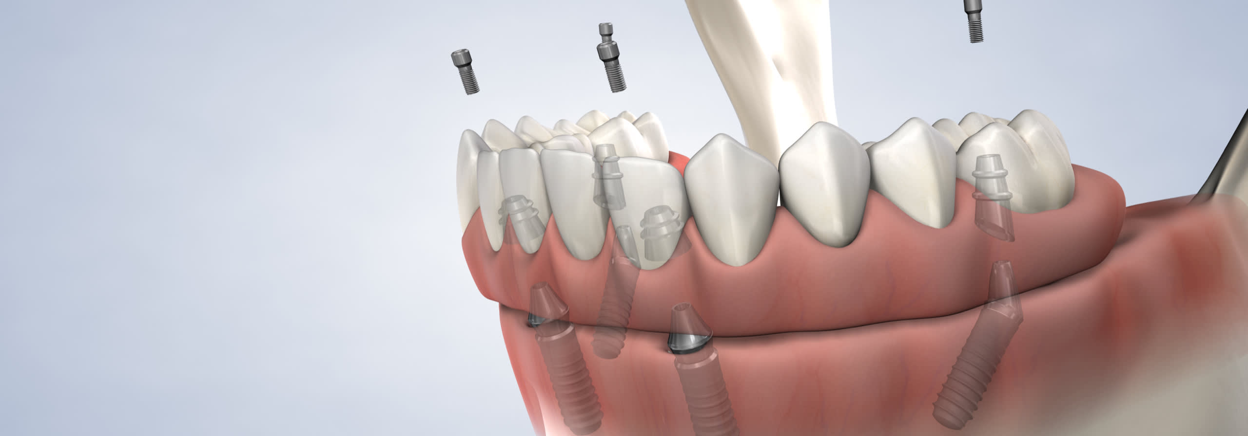 Full arch procedure desktop