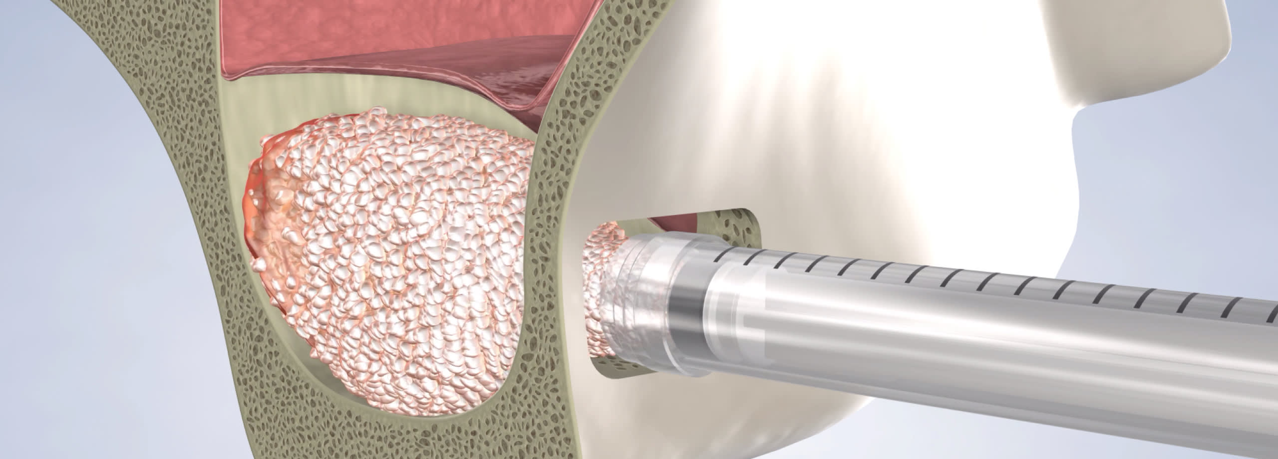 Procedure sinus lift video