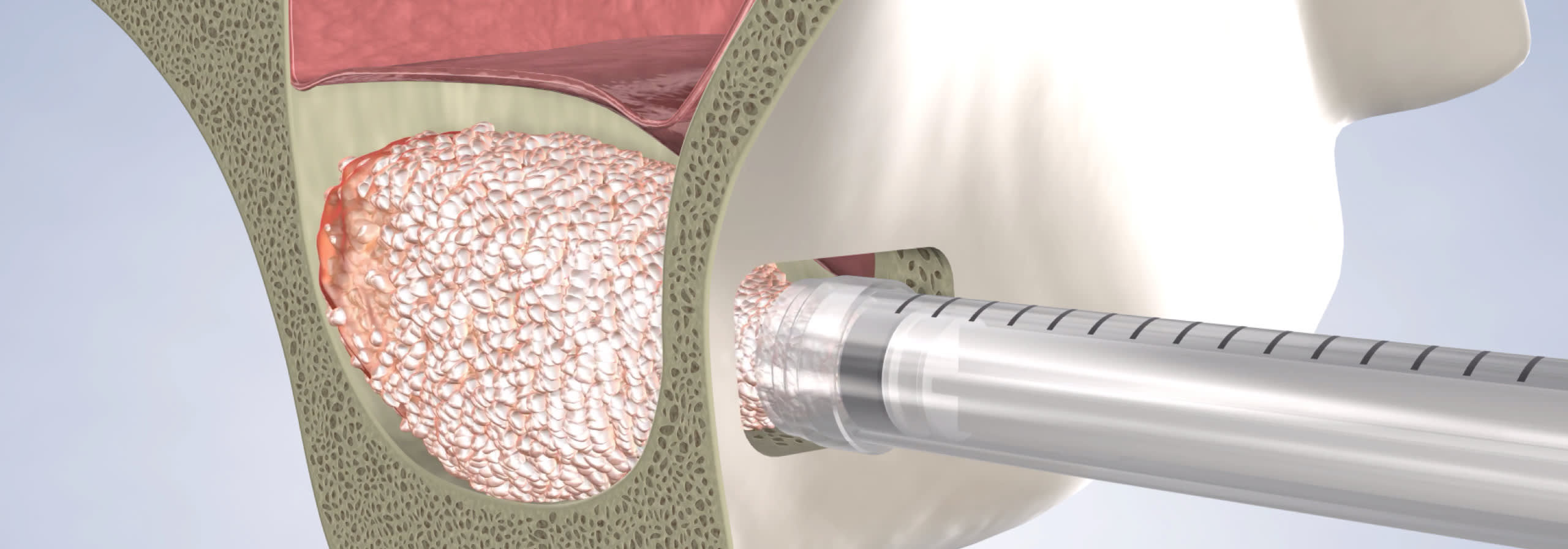 Sinus graft procedure desktop